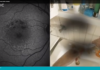 The Impact of GA Disease Progression retinal image of geographic atrophy on the left with impact to vision on the right. As GA progression continues, patient struggles.