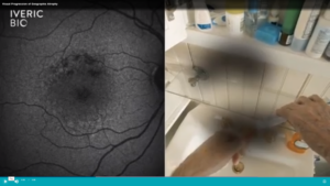 retinal image of geographic atrophy on the left with impact to vision on the right. As GA progression continues, patient struggles. 