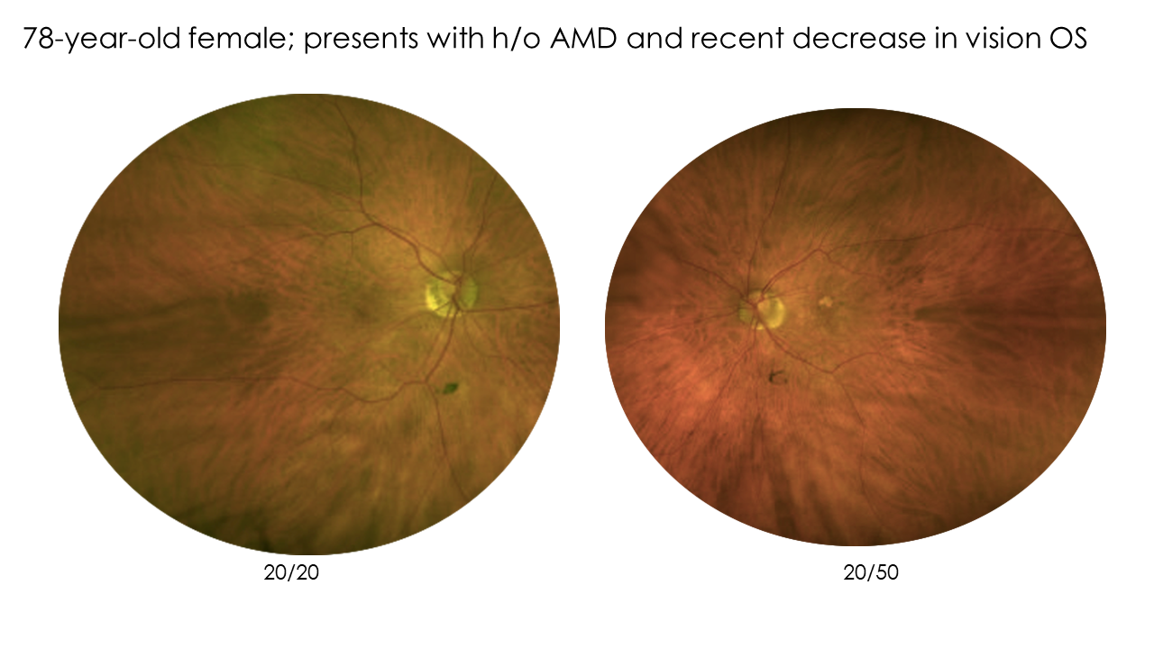 a set of three images provided by Dr. Rodman that show how she uses different kinds of images to detect geographic atrophy