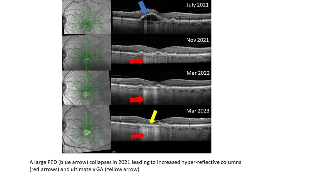 this OCT imags shows hyper-reflective columns and how one year later that shows up as GA