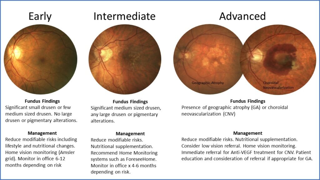 chart shows images of findings and the appropriate management for early, intermediate and advanced GA