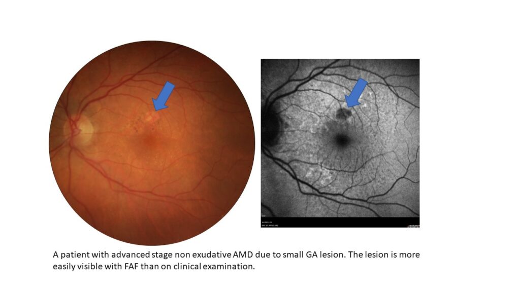 comparative images with FAF showing the lesion better