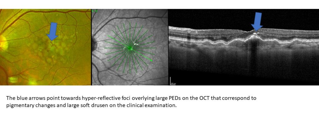 hyper reflective foci in three images. the condition shows up most clearly on the OCT image