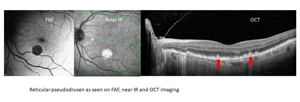 3 images of retircular pseudodrusen shown on FAF, near IR and OCT imagings