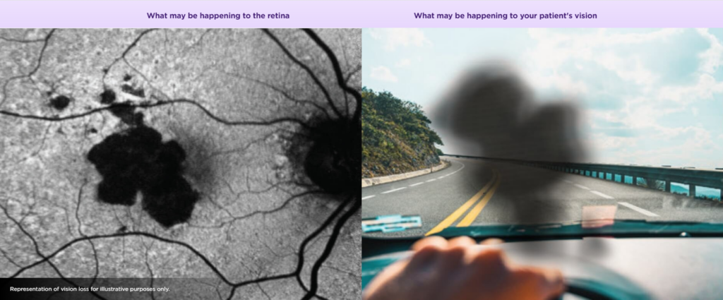 split screen image of retinal imaging showing ga and how it impact patient vision