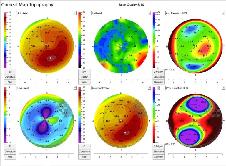 Posterior Float Topography Technology Transforming Care and Efficiency | Women In Optometry